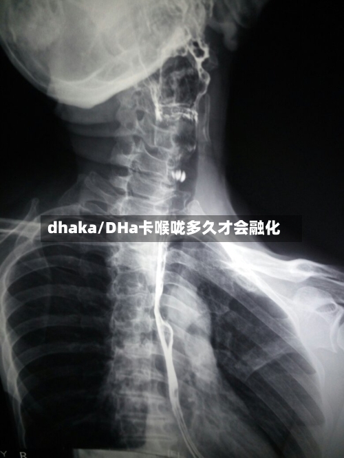 dhaka/DHa卡喉咙多久才会融化